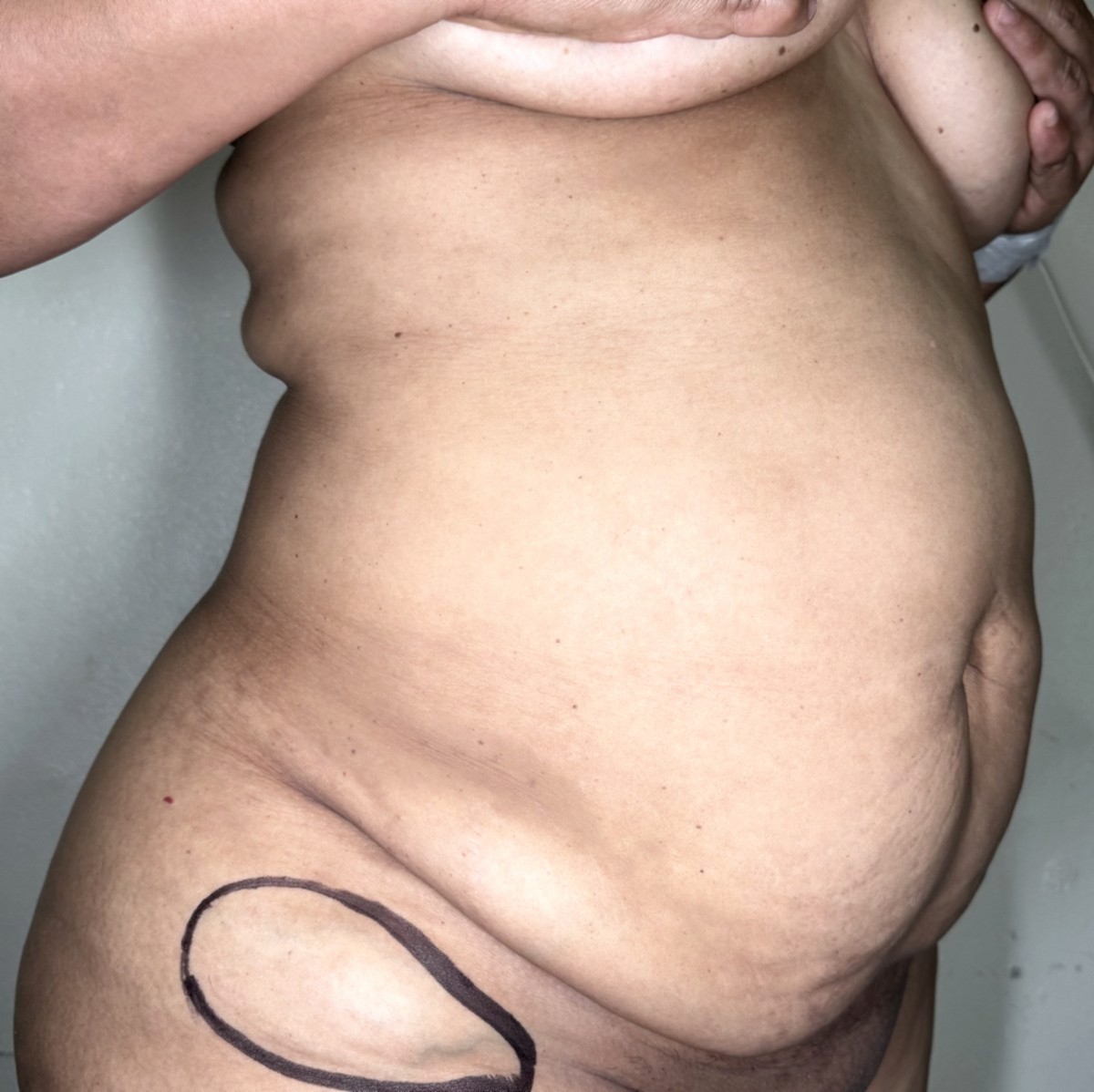 Abdominoplastia antes