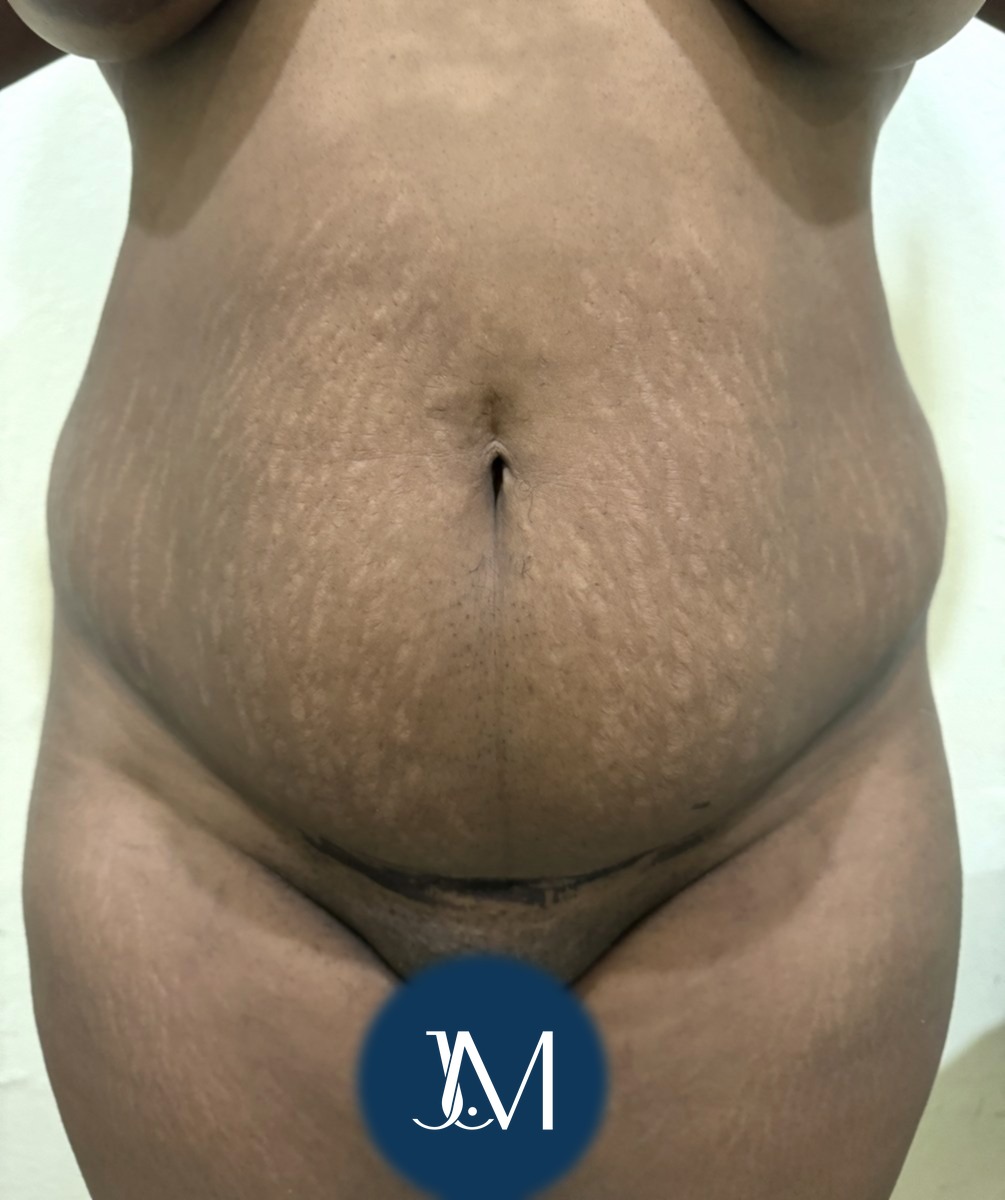 Abdominoplastia antes