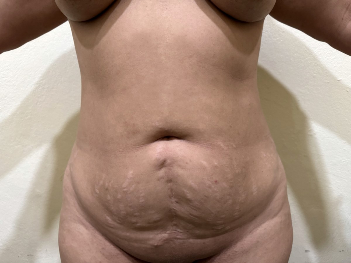 Abdominoplastia antes