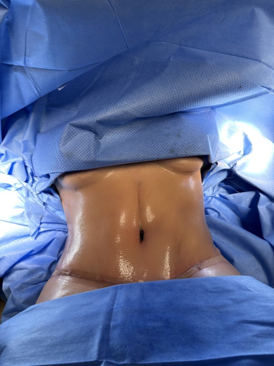 Abdominoplastia despu&eacute;s