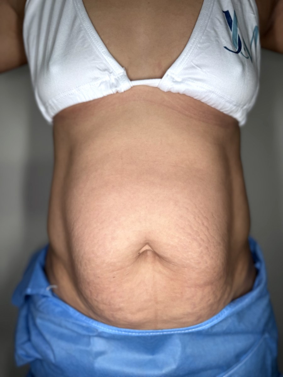 Abdominoplastia antes