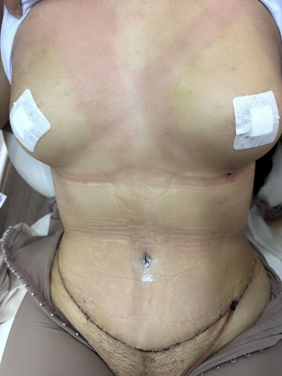 Abdominoplastia despu&eacute;s