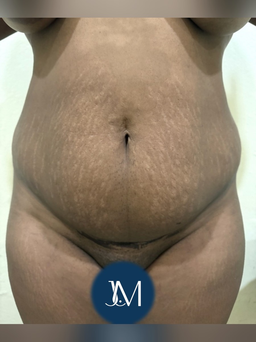 Abdominoplastia antes