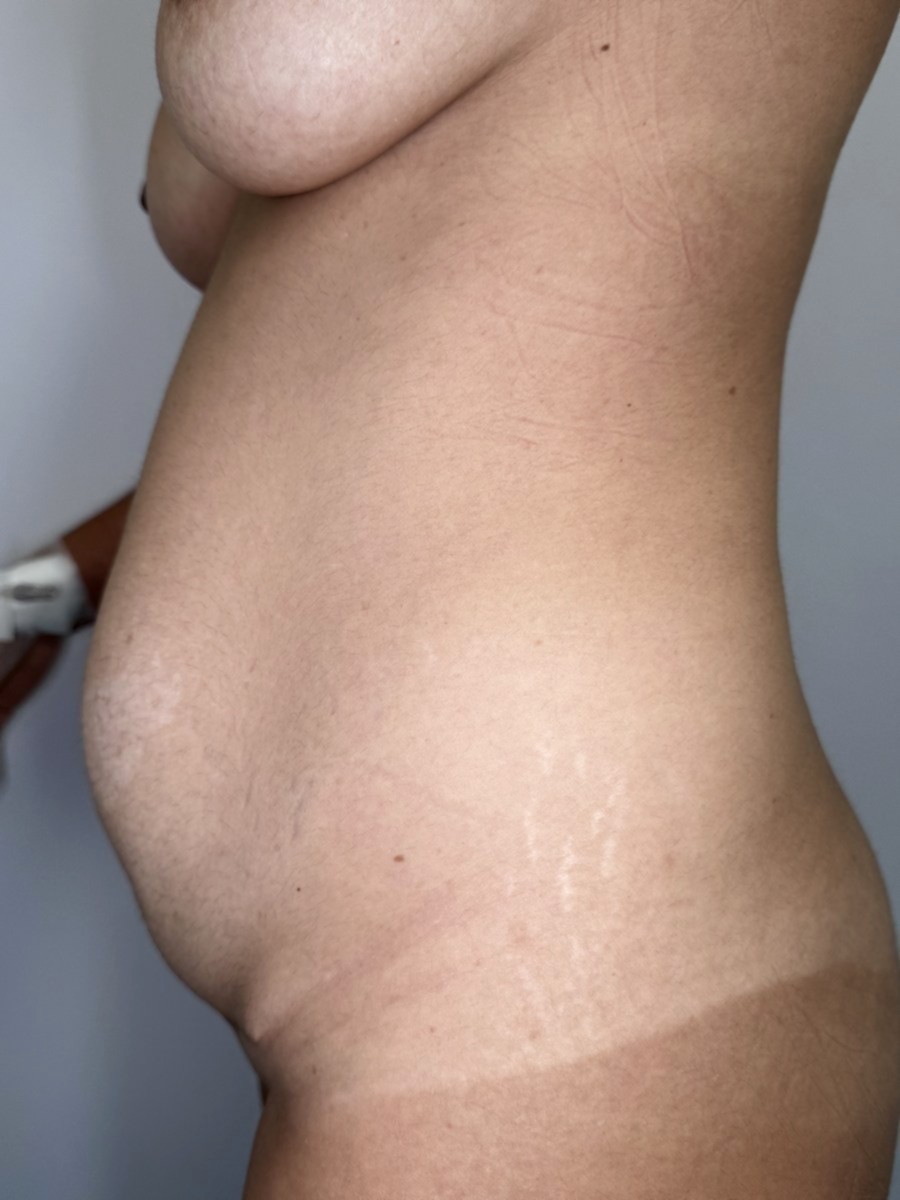 Abdominoplastia antes
