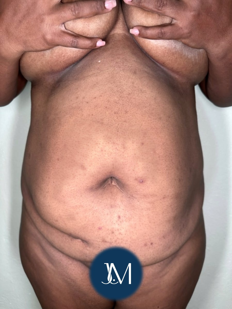 Abdominoplastia antes