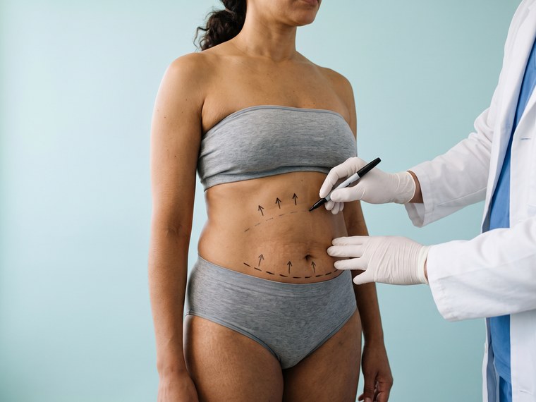 ¿Qué es la lipoabdominoplastia?