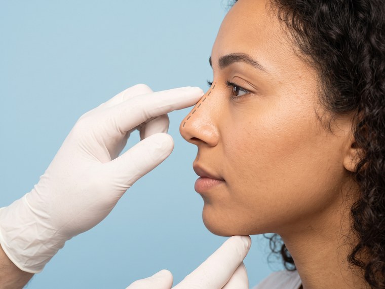 ¿Qué es la rinoplastia?